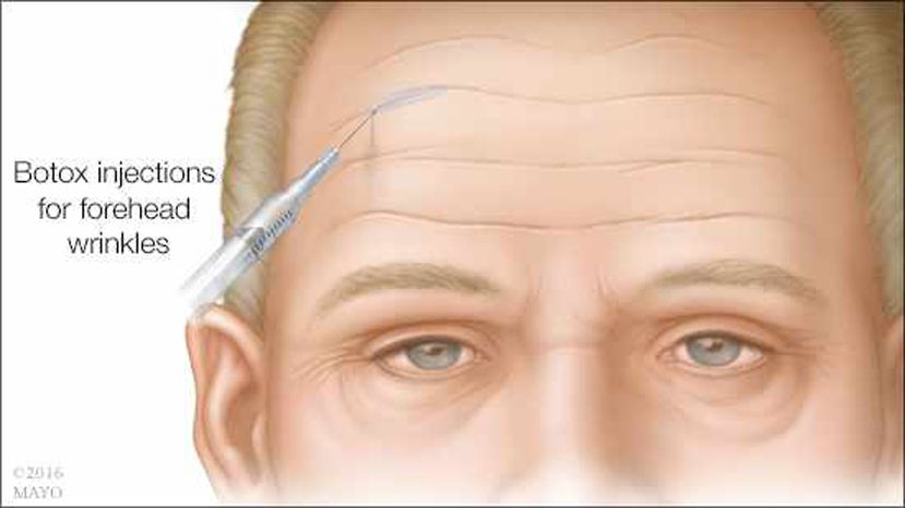 Mitos y realidades sobre el uso del botox para las arrugas